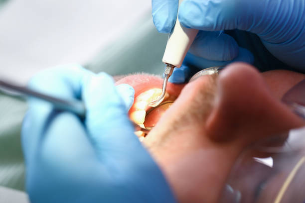 Best Emergency Wisdom Teeth Removal in Grandview, WA